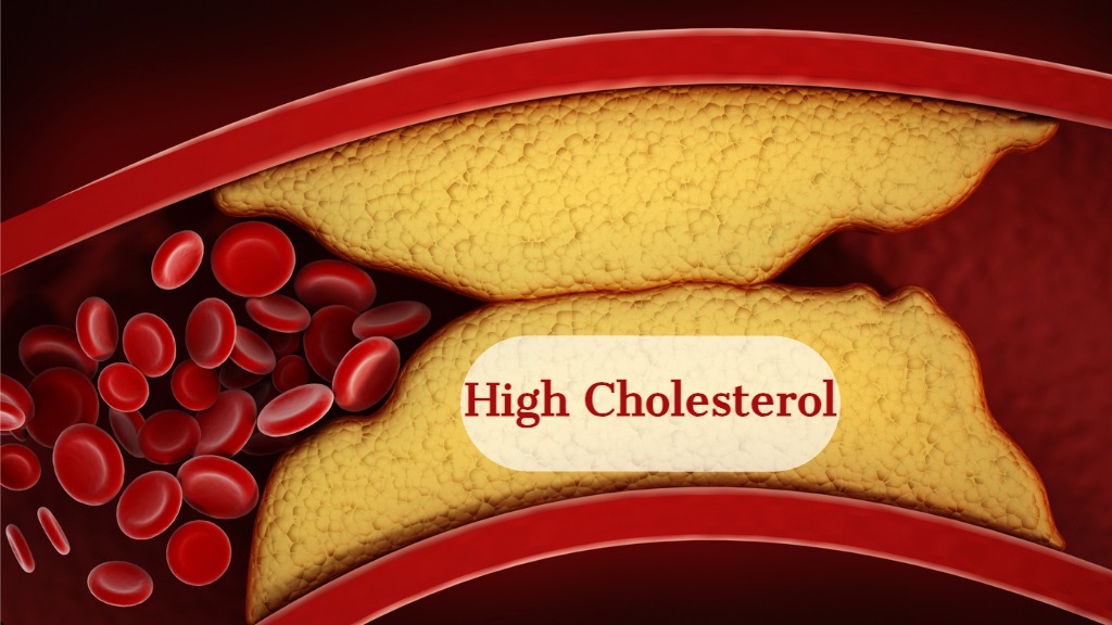 Numbness Isn’t Normal. Get Checked High Cholesterol? Know Your Arteries
