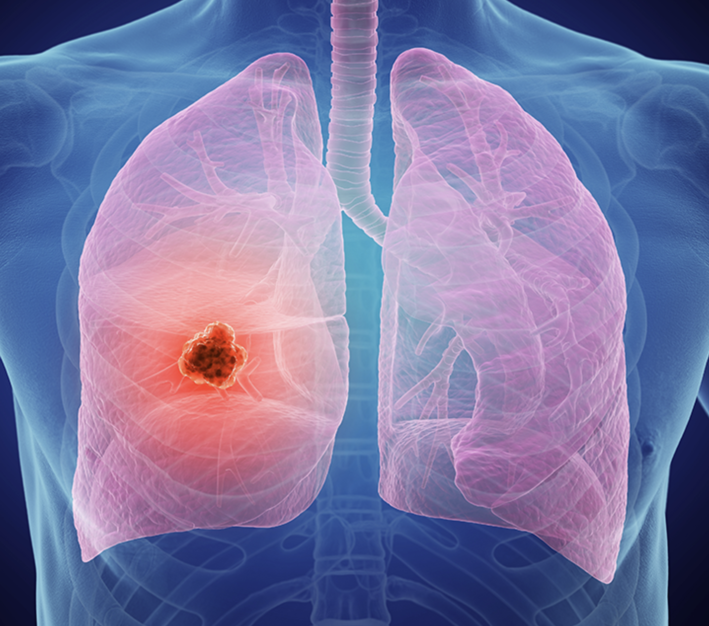 Lung Cancer Screening Lung CT Screening