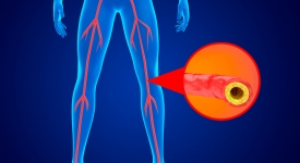 Dr. Karl Zhang treating peripheral artery disease with minimally invasive angioplasty in New York City