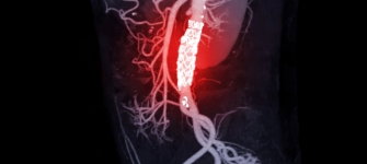 Aortic aneurysm 