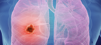 Lung CT Screening