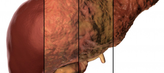Fatty Liver