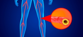Dr. Karl Zhang treating peripheral artery disease with minimally invasive angioplasty in New York City